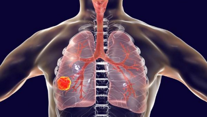 Akciğer kanserinde yeni tedaviler