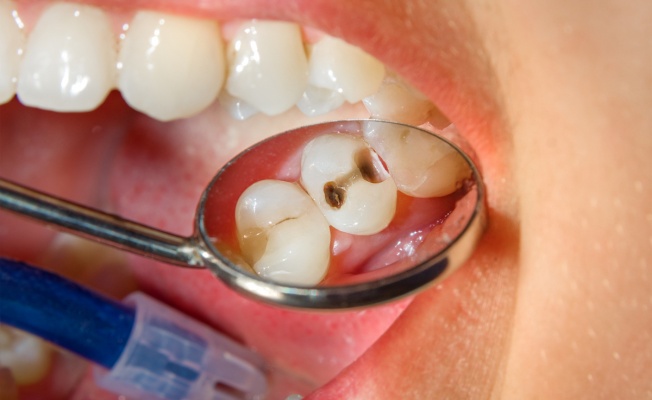 Gülümsemenizi korumanın anahtarı: Diş çürüğü tedavileri