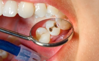 Gülümsemenizi korumanın anahtarı: Diş çürüğü tedavileri